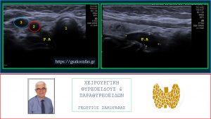Αδένωμα Παραθυρεοειδούς Σε Οπισθοκαρωτιδική Προσπονδυλική Θέση – Με Αφορμή Ασθενή Μας