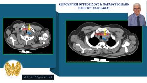Τομές στην αξονική τομογραφία. Αριστερά φαίνεται η στένωση της τραχείας (μπλε βέος) λόγω πίεσής της από τον διογκωμένο θυρεοειδή (κίτρινο βέλος). Αριστερά φαίνεται η κατάδυση του διογκωμένου θυρεοειδούς στο μεσοθωράκιο