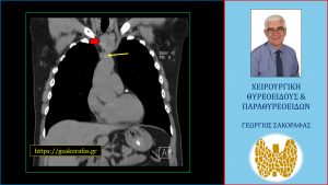 Όζος Θυρεοειδούς 1, Βαθιά Καταδυόμενος Στο Μεσοθωράκιο – Αφαίρεση Με Τραχηλική Τομή (Με Αφορμή Ασθενή Μας