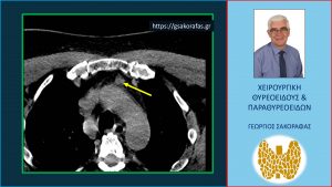 Αδένωμα Παραθυρεοειδούς (3) Σε Έκτοπη Βαθιά Ενδοθωρακική Θέση – Αφαίρεση Μέσω Τραχηλικής Τομής, Χωρίς Στερνοτομή