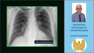 Στην Ακτινογραφία Θώρακος Παρατηρείται Απώθηση Της Τραχείας Προς Τα Αριστερά Από Τον Ευμεγέθη Δεξιό Λοβό Του Θυρεοειδούς (Βέλος).