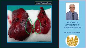 Χειρουργικό Παρασκεύασμα Ολικής Θυρεοειδεκτομής. Μεγάλου Βαθμού Διόγκωση Και Των Δύο Λοβών Και Κυρίως Του Δεξιού Λοβού. Για Λόγους Σύγκρισης, Με Το Πράσινο Περίγραμμα Απεικονίζεται Το Φυσιολογικό Μέγεθος Του Θυρεοειδούς Αδένα.