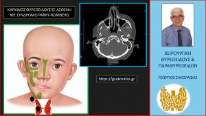 Καρκίνος Θυρεοειδούς 4 Σε Ασθενή Μας Με Σύνδρομο Parry-Romberg