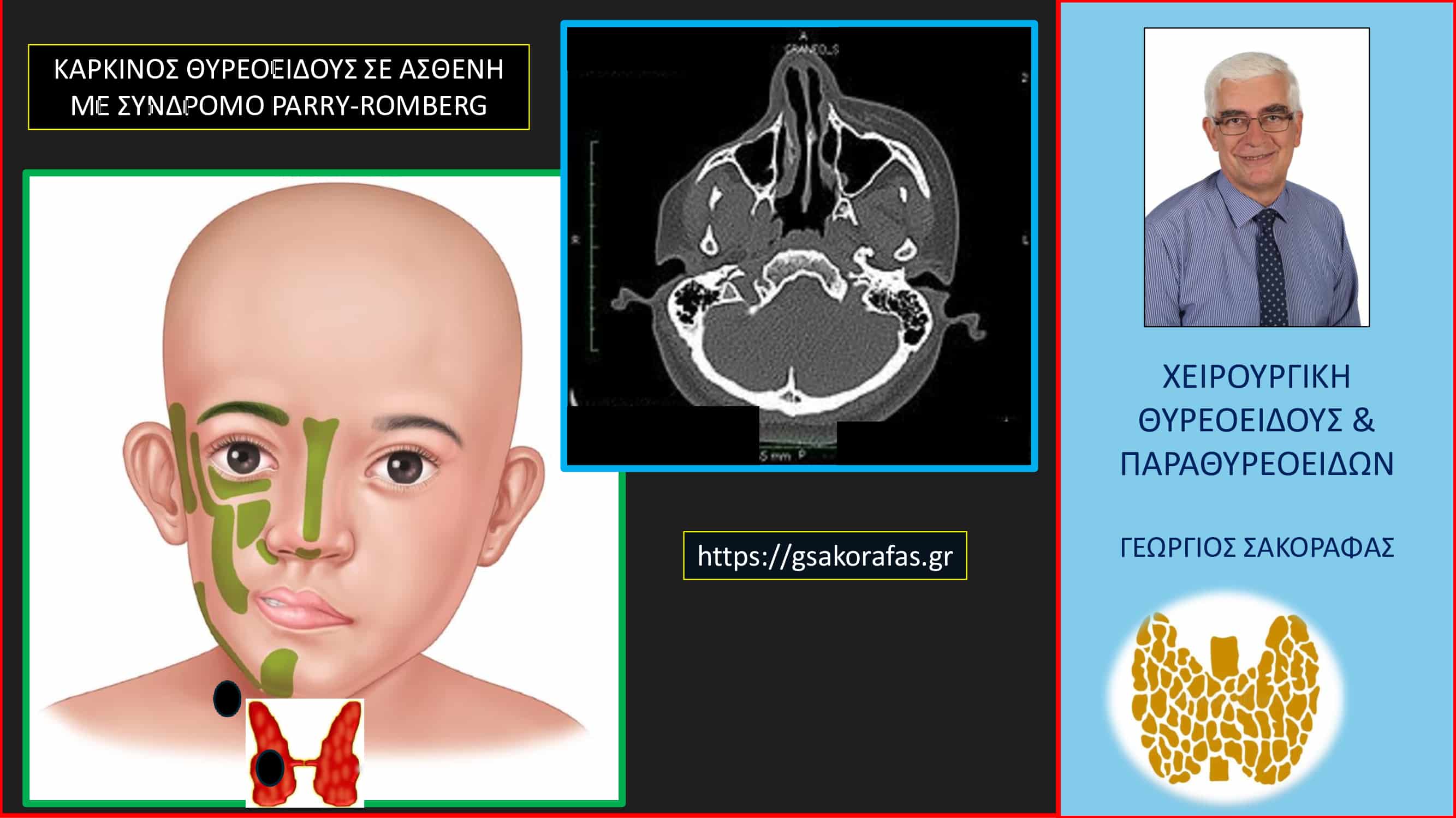 Καρκίνος θυρεοειδούς 4 σε ασθενή μας με σύνδρομο Parry-Romberg