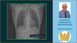 Ακτινογραφία Θώρακος - Εμφανής Η Παρεκτόπιση Της Τραχείας (Κίτρινο Βέλος) Προς Τα Αριστερά Λόγω Της Πίεσης Που Ασκείται Επ' Αυτής Από Τον Ευμεγέθη Όζο.