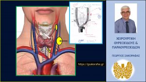 Καρκίνος Θυρεοειδούς &Amp; Μέγεθος – Έχει Σημασία Το Μέγεθός Του Για Την Παρουσία Μεταστάσεων Στους Λεμφαδένες Του Τραχήλου? (Με Αφορμή Ασθενή Μας). Σχηματική Αναπαράσταση Των Υπερηχογραφικών Ευρημάτων. Στο Ένθετοη Χαρτογράφηση Λεμφαδένων Τραχήλου