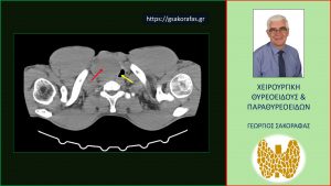 Αξονική Τομογραφία – Τομή Στο Ύψος Του Τραχήλου. Εμφανής Ο Ευμεγέθης Όζος (Κόκκινο Βέλος) Που Πιέζει Την Τραχεία (Κίτρινο Βέλος) Και Την Παρεκτοπίζει Προς Τα Αριστερά.