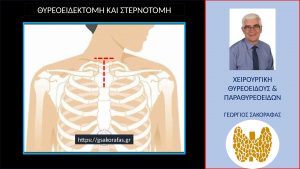 Θυρεοειδεκτομή Και Στερνοτομή - Τομή Εν Είδει Τ