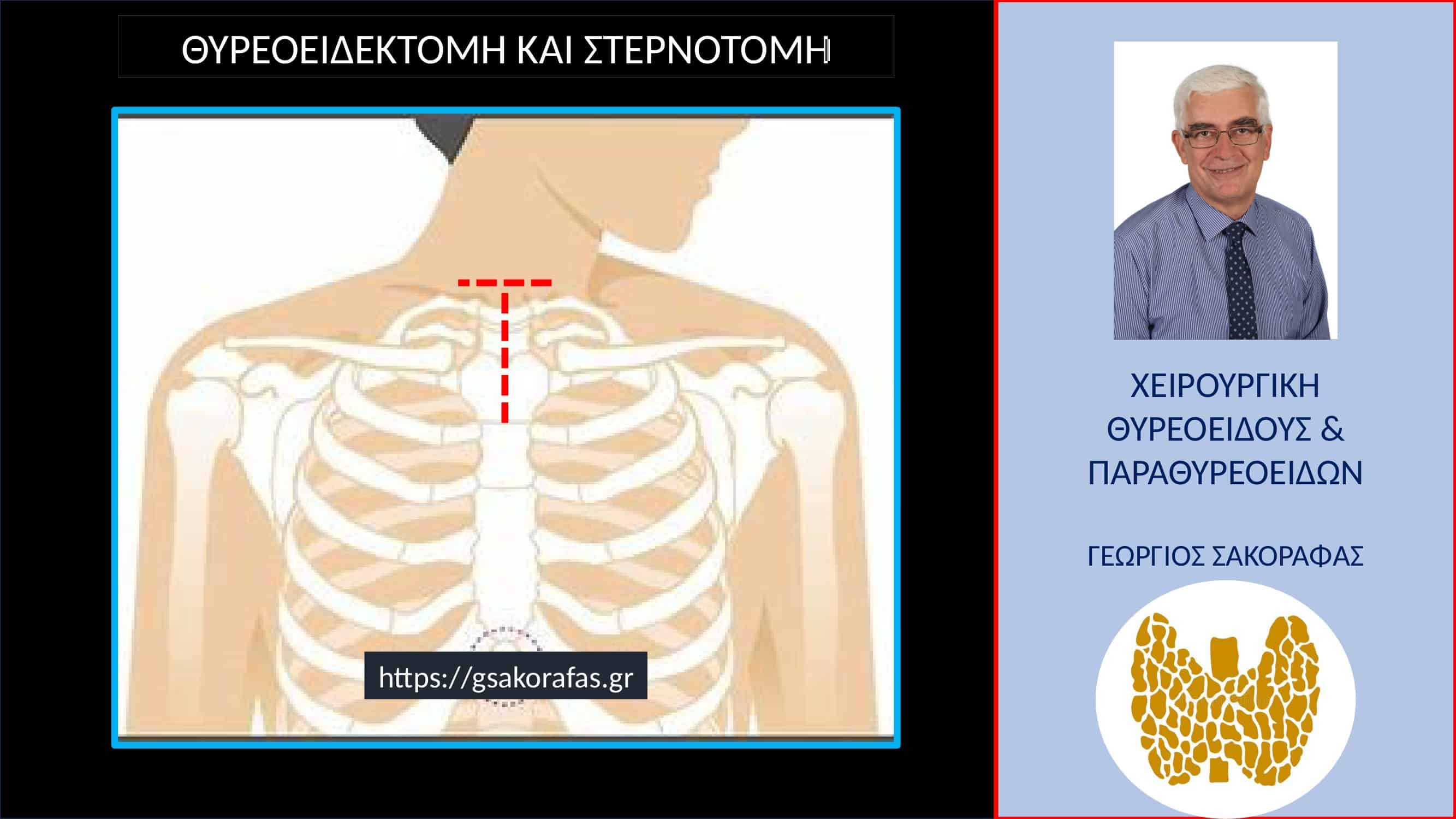 Θυρεοειδεκτομή και στερνοτομή