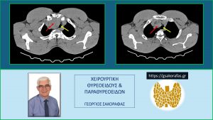 Όζος Θυρεοειδούς 3- Αξονική Τομογραφία: Τομές Σε Δύο Χαμηλότερα Επίπεδα, Όπου Φαίνεται Η Κατάδυση Του Ευμεγέθους Όζου (Κόκκινο Βέλος) Στο Μεσοθωράκιο Και Η Απώθηση Της Τραχείας (Κίτρινο Βέλος) Προς Την Αντίθετη Κατεύθυνση (Αριστερά). Στην Αριστερή Εικόνα Είναι Εμφανής Και Η Επιπέδωση Του Δεξιού Ορίου Της Τραχείας Λόγω Της Πίεσης Από Τον Όζο. Η Επιπέδωση Αυτή Προκαλεί Μείωση Της Διαμέτρου Του Αυλού Της Τραχείας, Όπως Είναι Εμφανές Στην Εικόνα.