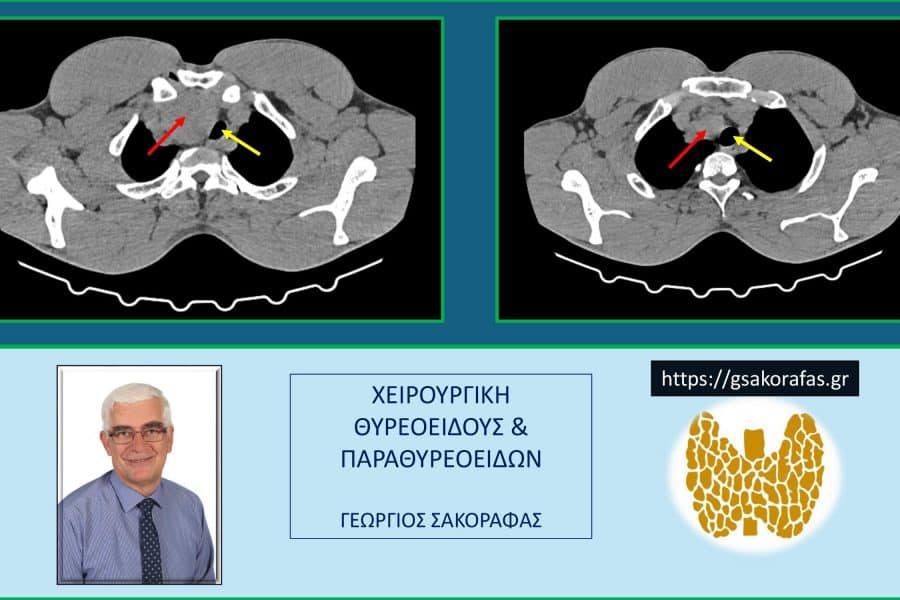 Όζος θυρεοειδούς 3- αξονική τομογραφία: τομές σε δύο χαμηλότερα επίπεδα, όπου φαίνεται η κατάδυση του ευμεγέθους όζου (κόκκινο βέλος) στο μεσοθωράκιο και η απώθηση της τραχείας (κίτρινο βέλος) προς την αντίθετη κατεύθυνση (αριστερά). Στην αριστερή εικόνα είναι εμφανής και η επιπέδωση του δεξιού ορίου της τραχείας λόγω της πίεσης από τον όζο. Η επιπέδωση αυτή προκαλεί μείωση της διαμέτρου του αυλού της τραχείας, όπως είναι εμφανές στην εικόνα.