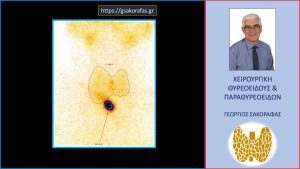 Όζοι Θυρεοειδούς Και Σπινθηρογράφημα (Εικόνα, Σε Ασθενή Μας)
