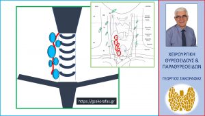 Καρκίνος Θυρεοειδούς – Επιπλεγμένη Περίπτωση Ασθενούς: Λεμφαδενικός Καθαρισμός Τραχήλου Με Διατήρηση Του Κάτω Λαρυγγικού Νεύρου Σε Πορεία Εν Μέσω Block Διηθημένων Λεμφαδένων (Υπολειμματική Νόσος)