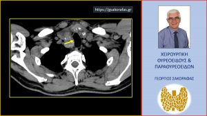 Ευμεγέθης Καταδυόμενη Βρογχοκήλη. Εμφανής Η Κατάδυση Του Θυρεοειδούς (Που Παρουσιάζει Μεγάλου Βαθμού Διόγκωση) Στο Μεσοθωράκιο Και Η Απώθηση Της Τραχείας Προς Τα Αριστερά Από Τον Περισσότερο Διογκωμένο Δεξιό Λοβό (Κίτρινο Βέλος)