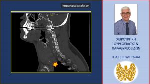 Εικόνα Σε Άλλη Τομή Της Αξονικής Τομογραφίας. Εμφανής Η Μεγάλου Βαθμού Διόγκωση Του Θυρεοειδούς Αδένα Και Η Κατάδυσή Του Στο Μεσοθωράκιο (Κίτρινο Βέλος)