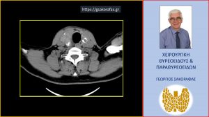 Αξονική Τομογραφία (Εικόνα Από Τομή Στο Ύψος Του Τραχήλου) - Εμφανής Η Μεγάλου Βαθμού Διόγκωση Του Θυρεοειδούς
