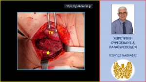 Χειρουργικά ευρήματα – αρχική φάση επέμβασης. Μετά την ανάσπαση του λοβού του θυρεοειδούς (TH) προς την μέση γραμμή, έχει ανευρεθεί το αδένωμα (κίτρινο βέλος), σε βαθιά θέση, όπως περιγράφεται στο κείμενο.