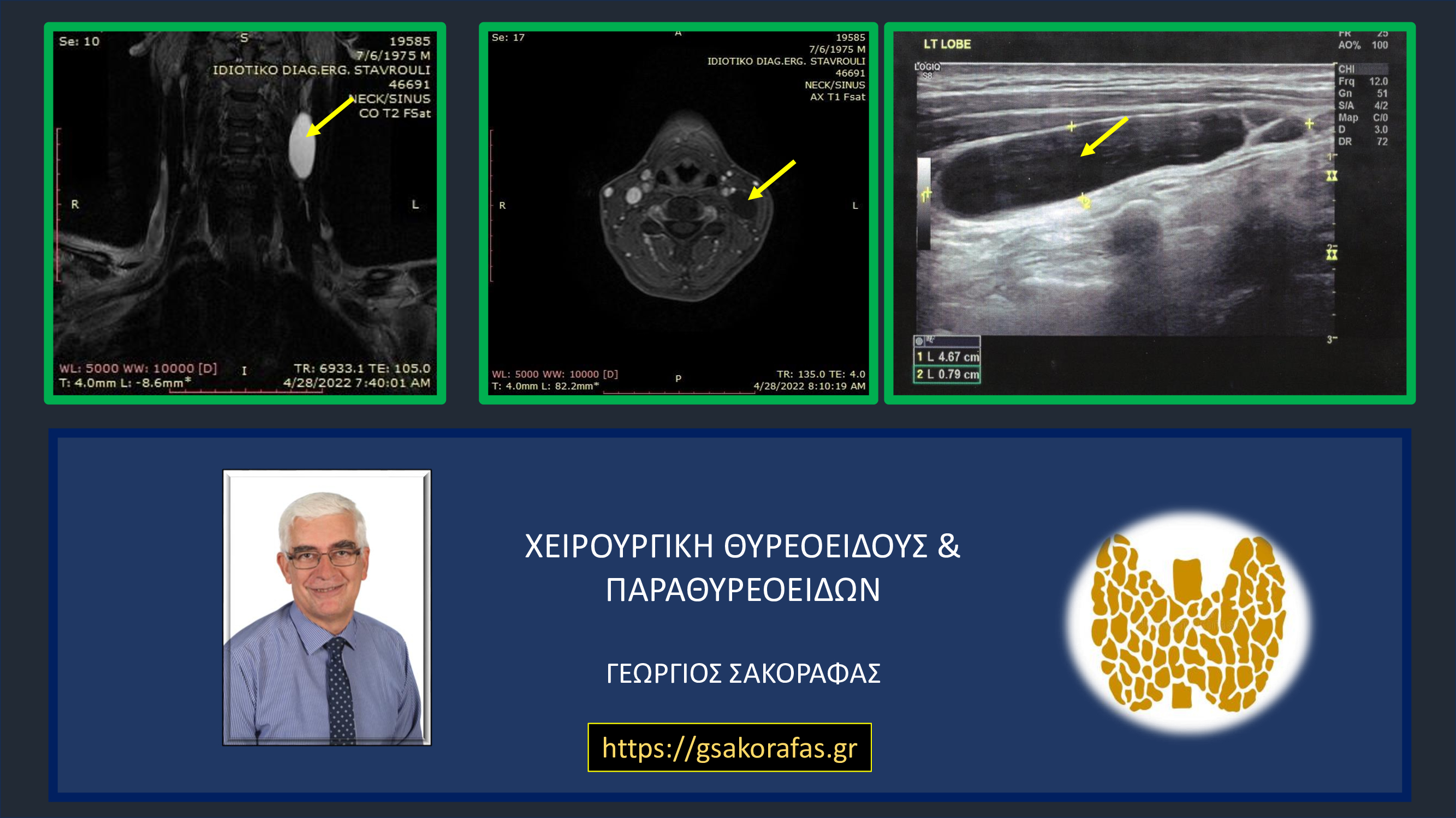 Κύστη τραχήλου – μία πιθανή διαγνωστική παγίδα: με αφορμή ασθενή μας