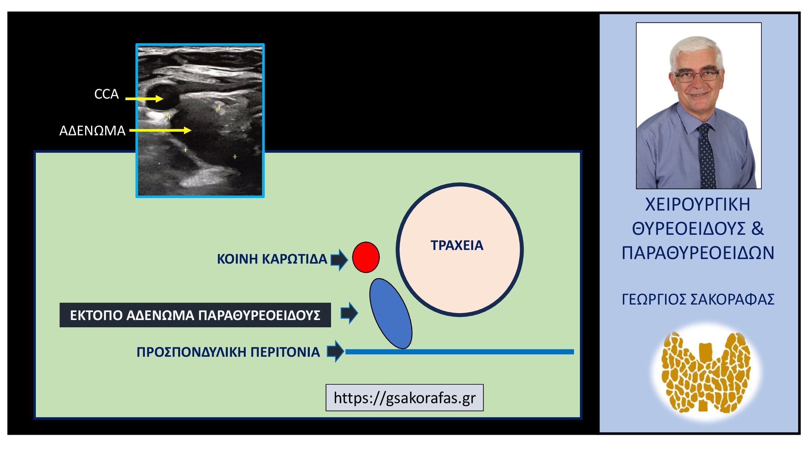 Έκτοπο αδένωμα παραθυρεοειδούς (οπισθοκαρωτιδικό, προσπονδυλικό)