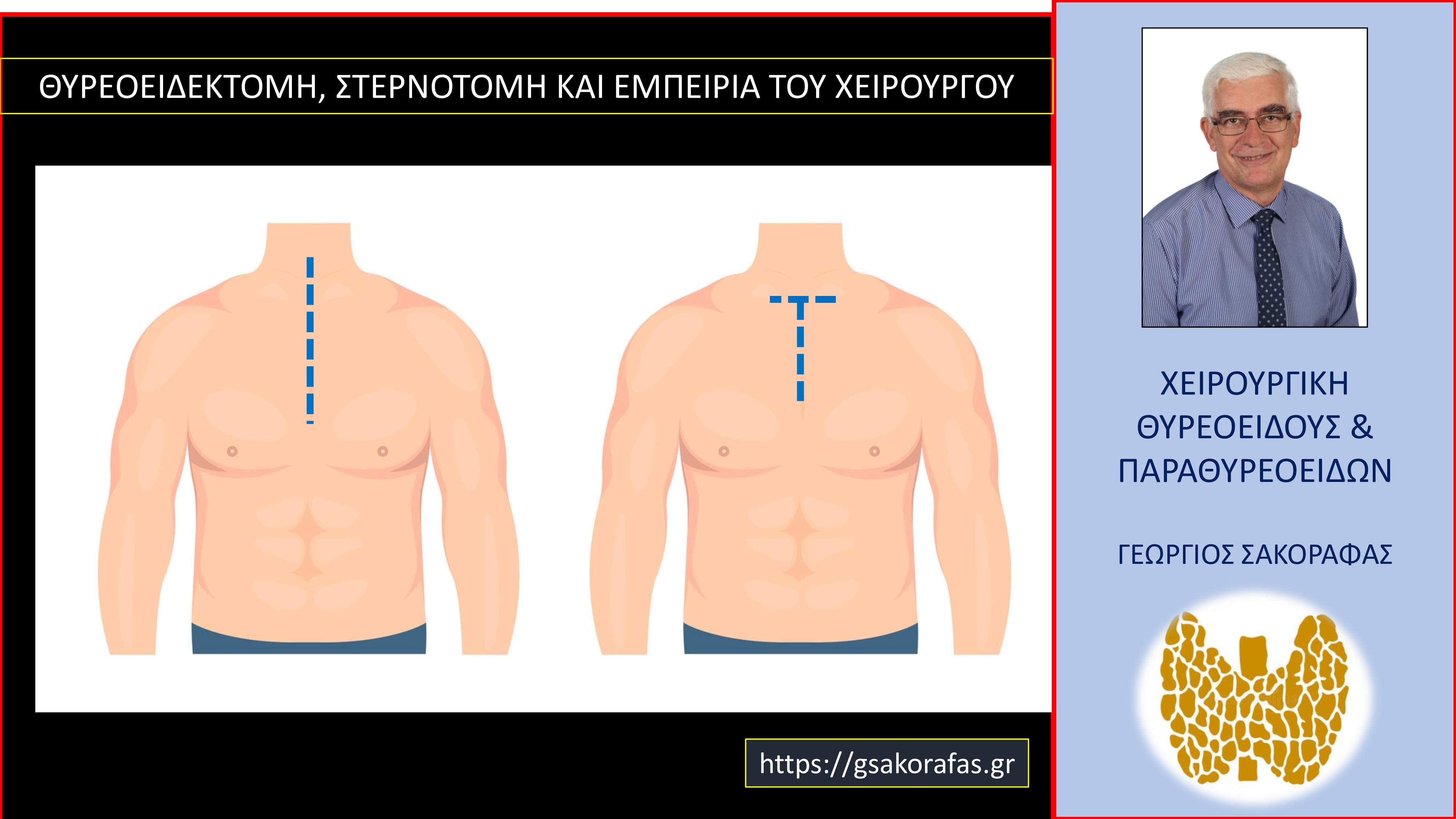 Θυρεοειδεκτομή στερνοτομή και η σημασία της εμπειρίας του χειρουργού