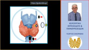 Καρκίνος Θυρεοειδούς – Μία Διαγνωστική «Παγίδα» Και Ένα Πιθανό Διαγνωστικό Λάθος (Με Αφορμή Νεαρό Ασθενή Μας)-Ευρήματα Στον Ασθενή Μας (Βλ. Κείμενο), Μπλέ Βέλος=Η Πρωτοπαθής Εστία (Πολύ Μικρή), Κίτρινο Βέλος=Ο Κυστικά Εκφυλισμένος Λεμφαδένας (Με Μεταστατική Διήθηση), Μαύρα Βέλη=Μεταστατικά Διηθημένοι Λεμφαδένες