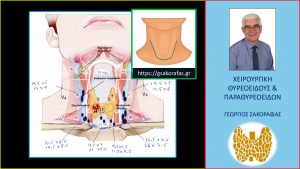 Αμφοτερόπλευρος Λεμφαδενικός Καθαρισμός Τραχήλου Σε Ασθενή Μας Με Καρκίνο Θυρεοειδούς Και Εκτεταμένη Λεμφαδενική Διασπορά.