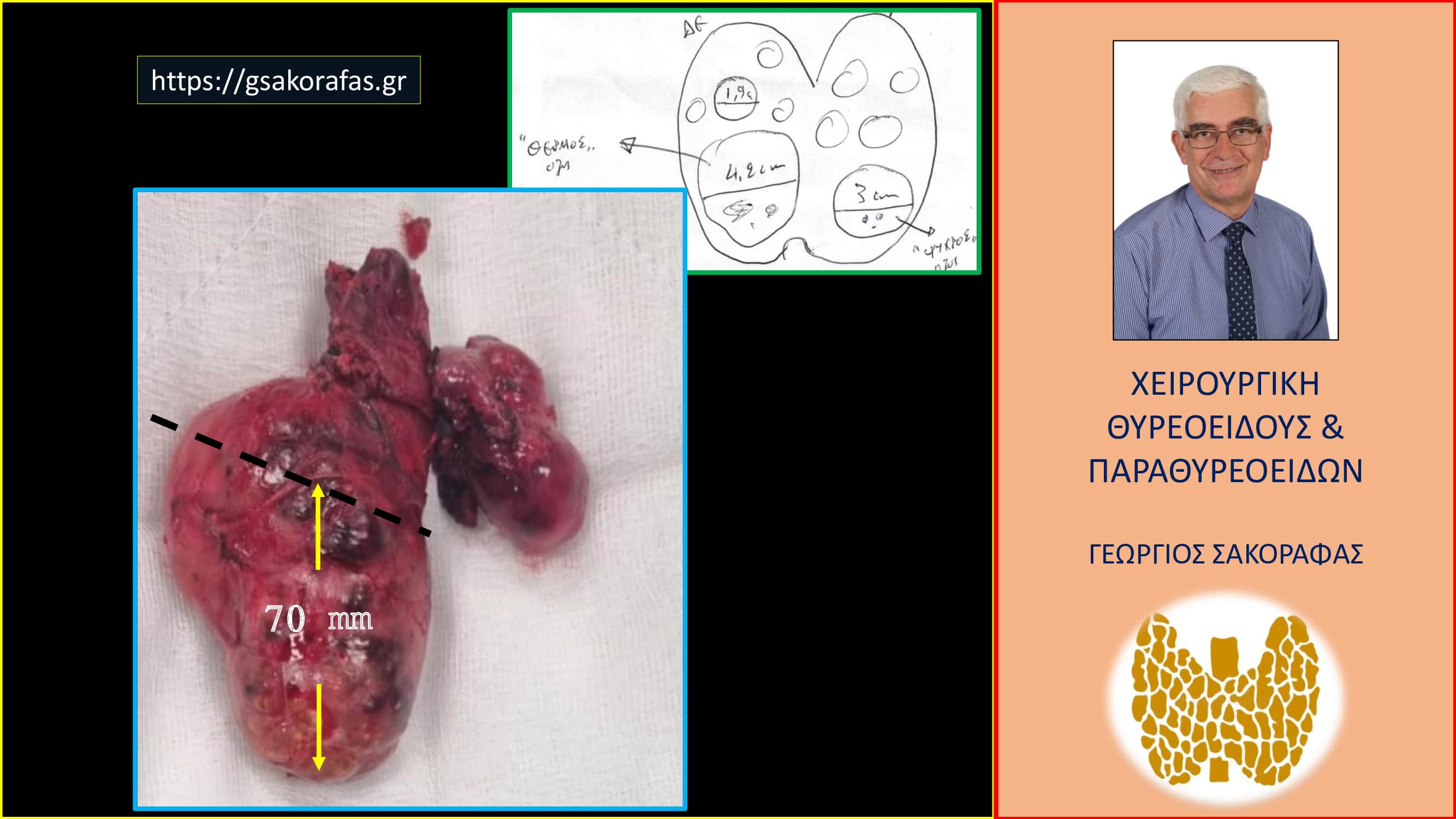 Θυρεοειδεκτομή – μη αναμενόμενα ευρήματα: πρακτική σημασία (με αφορμή ασθενή μας)