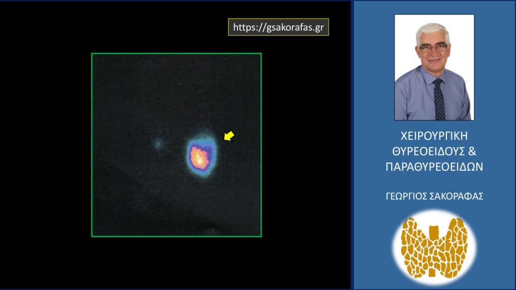 Τοξικό αδένωμα θυρεοειδούς - σπινθηρογραφικά ευρήματα (βλ. κείμενο)