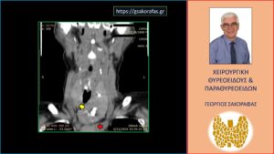Βρογχοκήλη Καταδυόμενη Μέχρι Το Ύψος Του Αορτικού Τόξου Σε Ηλικιωμένη Ασθενή Μας– Αφαίρεση Μέσω Της Τραχηλικής Τομής 