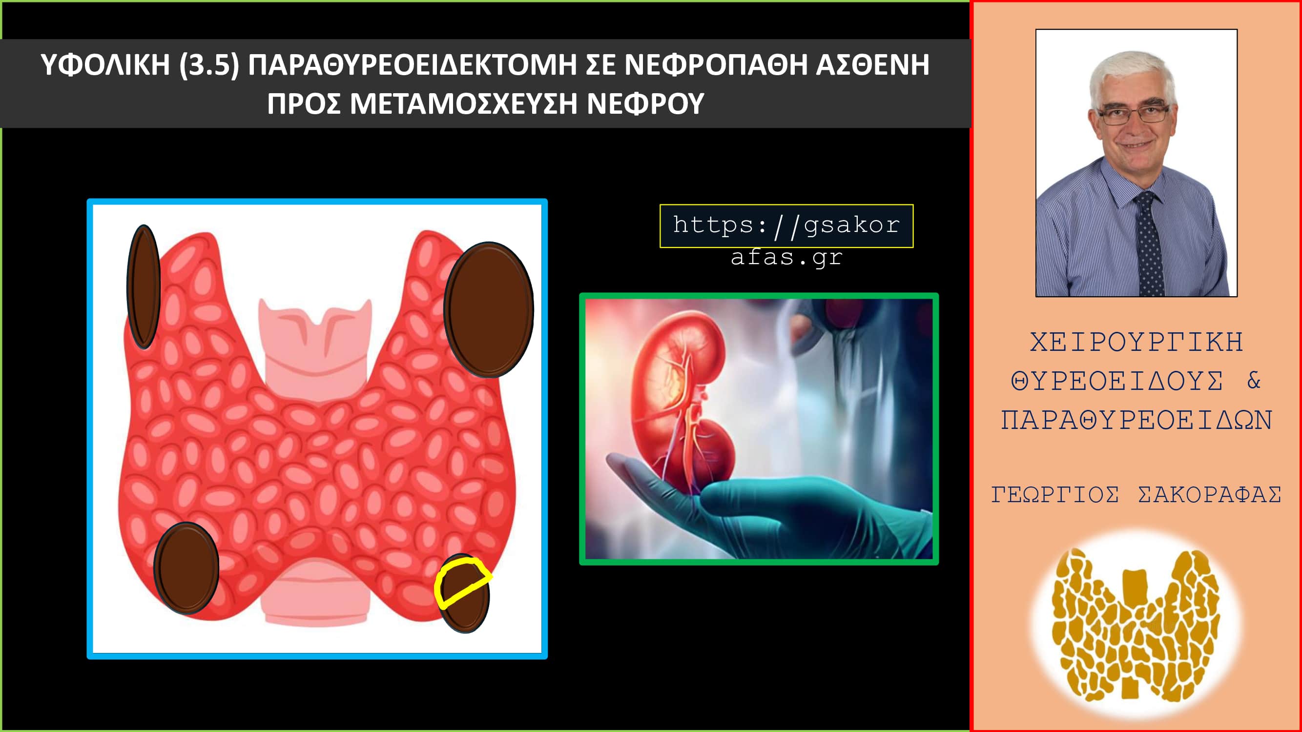 Υφολική παραθυρεοειδεκτομή (3.5) σε ασθενή με τριτοπαθή υπερπαραθυρεοειδισμό και χρόνια νεφρική ανεπάρκεια σε αναμονή για μεταμόσχευση νεφρού