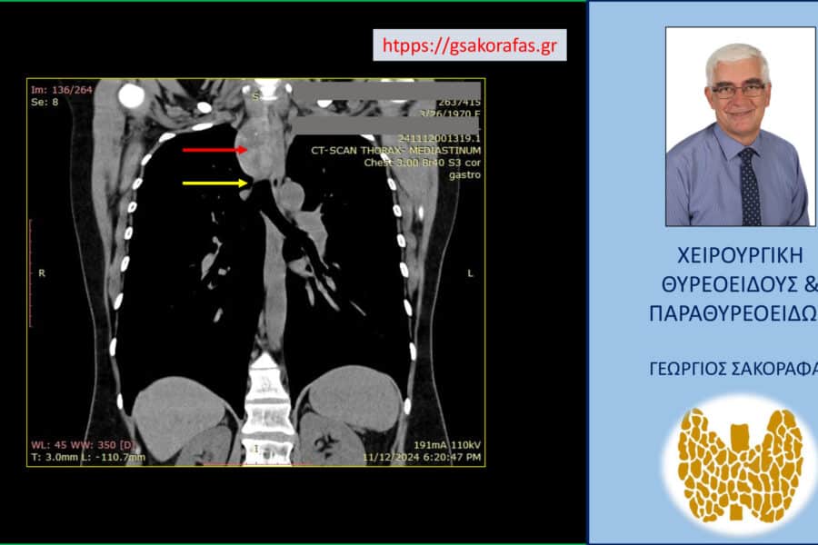 Καταδυόμενος όζος θυρεοειδούς - εμφανής η βαθιά κατάδυση του όζου (κόκκινο βέλος) μέχρι το σημείο του διχασμού της τραχείας (τρόπιδα, κίτρινο βέλος)
