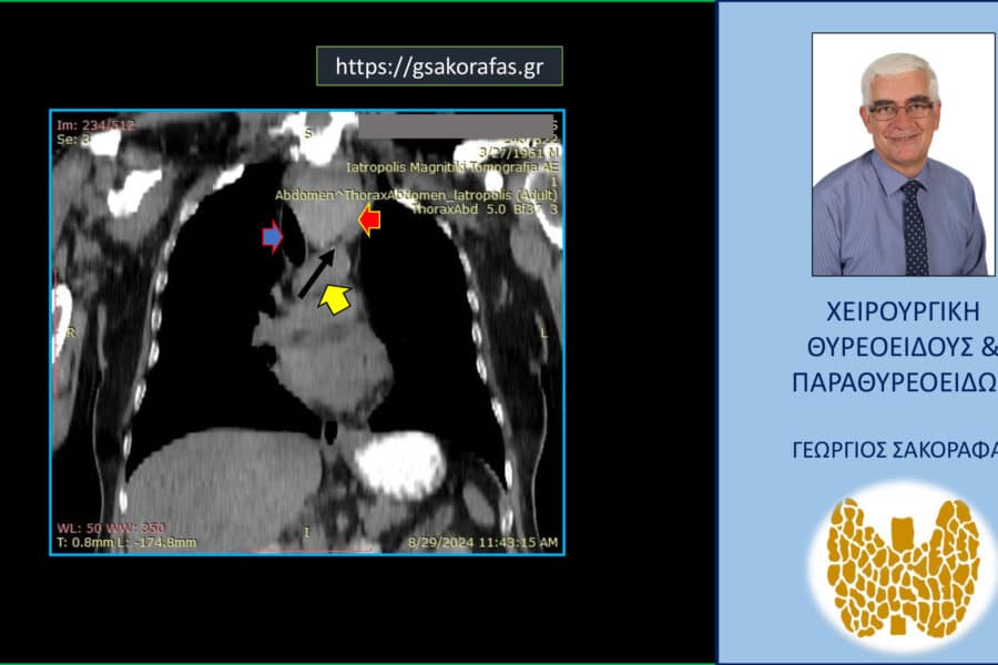 Καταδυόμενη βρογχοκήλη (εικόνα από ασθενή μας)
