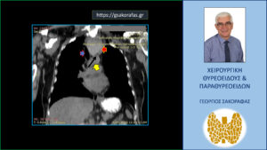 Εικόνα Από Την Αξονική Τομογραφία. Εμφανής Η Μεγάλου Βαθμού Κατάδυση Του Θυρεοειδούς Στο Θώρακα (Κόκκινο Βέλος), Που Φθάνει Μέχρι Το Αορτικό Τόξο (Κίτρινο Βέλος). Το Μαύρο Βέλος Υποδεικνύει Το Όριο Μεταξύ Του Καταδυόμενου Θυρεοειδούς Και Του Αορτικού Τόξου. Εμφανής Και Η Απώθηση Της Τραχείας Προς Τα Δεξιά (Μπλε Βέλος). Λόγω Της Πίεσης Εκ Των Έξω Από Τον Διογκωμένο Θυρεοειδή, Η Τραχεία Παρουσιάζει Στένωση Του Αυλού Της, Έχοντας Ελλειψοειδές Σχήμα (Αντί Του Κυκλικού).