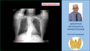 Εμφανής η απώθηση της τραχείας (βέλος) προς τα αριστερά από τον λίαν ευμεγέθη καταδυόμενο δεξιό λοβό του θυρεοειδούς (διακρίνεται το περίγραμμα του καταδυόμενου δεξιού λοβού). 