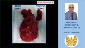 Χειρουργικό παρασκεύασμα – ο θυρεοειδής αδένας μετά την ολοκλήρωση της αφαίρεσής του μέσω της τραχηλικής τομής. Εμφανής η πολύ μεγάλου βαθμού διόγκωση του δεξιού λοβού (για λόγους σύγκρισης, ο αριστερός λοβός παρουσιάζει οριακά αυξημένο μέγεθος). Ενδεικτικά η κεφαλοουραία, η εγκαρσία και η προσθιοπίσθια διάμετρος του δεξιού λοβού είναι 145 mm, 85 mm και 80 mm. H διακεκομμένη μαύρη γραμμή αντιστοιχεί (σχηματικά) στη δεξιά κλείδα (το μεγαλύτερο μέρος του δεξιού λοβού – αυτό που είναι κάτω από την διακεκομμένη γραμμή - καταδύεται στο θώρακα)