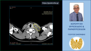 Καρκίνος Θυρεοειδούς – Παρουσίαση Με Λίαν Ευμεγέθη Λεμφαδενική Μετάσταση Σε Νεαρό Ασθενή Μας Με Μικροσκοπικό Θηλώδη Καρκίνο Θυρεοειδούς-Η Εικόνα Της Μετάστασης Στην Αξονική Τομογραφία (Με Το Κίτρινο Περίγραμμα)