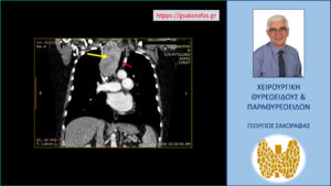Αξονική τομογραφία – εμφανής η μεγάλου βαθμού κατάδυση του δεξιού λοβού στο θώρακα (κίτρινο βέλος) και η απώθηση της τραχείας (κόκκινο βέλος) προς τα αριστερά 
