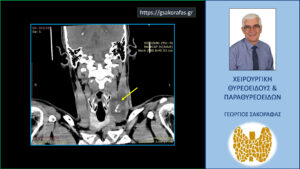 Καρκίνος Θυρεοειδούς – Παρουσίαση Με Λίαν Ευμεγέθη Λεμφαδενική Μετάσταση Σε Νεαρό Ασθενή Μας Με Μικροσκοπικό Θηλώδη Καρκίνο Θυρεοειδούς-Απεικόνιση Σε Άλλη Τομή (Κίτρινο Βέλος)