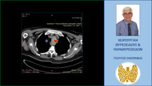 Καταδυόμενη Βρογχοκήλη Σε Βάθος Μέχρι Το Αορτικό Τόξο – Αφαίρεση Μέσω Της Τραχηλικής Τομής - Εικόνες (Με Αφορμή Ασθενή Μας). Εγκάρσια Τομή Στην Αξονική Τομογραφία - Θώρακας: Καταδυόμενος Θυρεοειδής (Κόκκινο Βέλος) Και Τραχεία (Μπλε Βέλος). Στις Βαθύτερες Τομές Της Αξονικής Τομογραφίας Στο Θώρακα Φαίνεται Η Ακόμη Βαθύτερη Κατάδυση Του Θυρεοειδούς Μέχρι Το Άνω Όριο Του Αορτικού Τόξου (Βλ. Δύο Επόμενες Εικόνες).