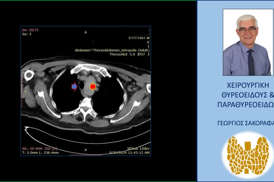 Καταδυόμενη βρογχοκήλη σε βάθος μέχρι το αορτικό τόξο – αφαίρεση μέσω της τραχηλικής τομής - εικόνες (με αφορμή ασθενή μας). Εγκάρσια τομή στην αξονική τομογραφία - θώρακας: καταδυόμενος θυρεοειδής (κόκκινο βέλος) και τραχεία (μπλε βέλος). Στις βαθύτερες τομές της αξονικής τομογραφίας στο θώρακα φαίνεται η ακόμη βαθύτερη κατάδυση του θυρεοειδούς μέχρι το άνω όριο του αορτικού τόξου (βλ. δύο επόμενες εικόνες).