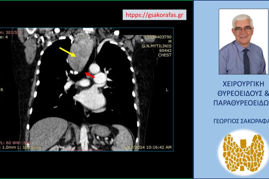 Καταδυόμενη βρογχοκήλη με εξαιρετικά μεγάλο βάθος κατάδυσης στο θώρακα σε υπερήλικα ασθενή