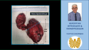 Χειρουργικό Παρασκεύασμα – Ο Καταδυόμενος Θυρεοειδής Αδένας Μετά Την Εκτομή Του. Και Ο Δεξιός Λοβός Είναι Διογκωμένος, Ο Αριστερός Όμως Λοβός Παρουσιάζει Πολύ Μεγαλύτερου Βαθμού Διόγκωση Και Καταδύεται Στο Θώρακα. Η Διακεκομμένη Μπλε Λοξή Γραμμή Αντιστοιχεί Στην Κλείδα. Το Μέρος Του Θυρεοειδούς Που Βρίσκεται Κάτω Από Τη Γραμμή Αυτή Είναι Το Καταδυόμενο Τμήμα Του Αδένα. Οι Αριθμοί Υποδηλώνουν Τις Δύο Διαστάσεις Του Θυρεοειδούς Που Φαίνονται Στην Εικόνα (Κεφαλοουραία Διάμετρος 120 Mm Και Εγκάρσια Διάμετρος 90 Mm.