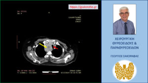 Αξονική τομογραφία – εγκάρσια διατομή. Ο διογκωμένος δεξιός λοβός (κόκκινο βέλος) απωθεί προς τα αριστερά την τραχεία (κίτρινο βέλος)