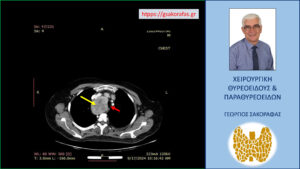 Αξονική τομογραφία – εγκάρσια διατομή σε χαμηλότερο επίπεδο. Ο διογκωμένος δεξιός λοβός (κόκκινο βέλος) απωθεί προς τα αριστερά την τραχεία (κίτρινο βέλος). Εμφανής η κατάδυση στο θώρακα και η στένωση του αυλού της τραχείας