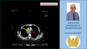 Αξονική τομογραφία – εγκάρσια διατομή σε ακόμη χαμηλότερο επίπεδο. Ο διογκωμένος δεξιός λοβός (κόκκινο βέλος) απωθεί προς τα αριστερά την τραχεία (κίτρινο βέλος). Εμφανής η κατάδυση στο θώρακα και η στένωση του αυλού της τραχείας