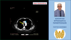 Αξονική τομογραφία – εγκάρσια διατομή στο ύψος που περίπου τελειώνει ο καταδυόμενος δεξιός λοβός (κίτρινο βέλος). Το σημείο αυτό βρίσκεται σε μεγάλο βάθος, περίπου στη μεσότητα του θώρακα