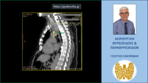 Καταδυόμενη Βρογχοκήλη Σε Βάθος Μέχρι Κάτωθεν Του Αορτικού Τόξου Σε Υπερήλικα Ασθενή. Στην Τομή Αυτή Της Αξονικής Τομογραφίας Φαίνεται Από Τα Πλάγια Η Επέκταση Του Κάτω Πόλου Του Αριστερού Λοβού Του Θυρεοειδούς (Πράσινο Βέλος) Κάτωθεν Του Άνω Ορίου Του Αορτικού Τόξου (Κίτρινο Βέλος).