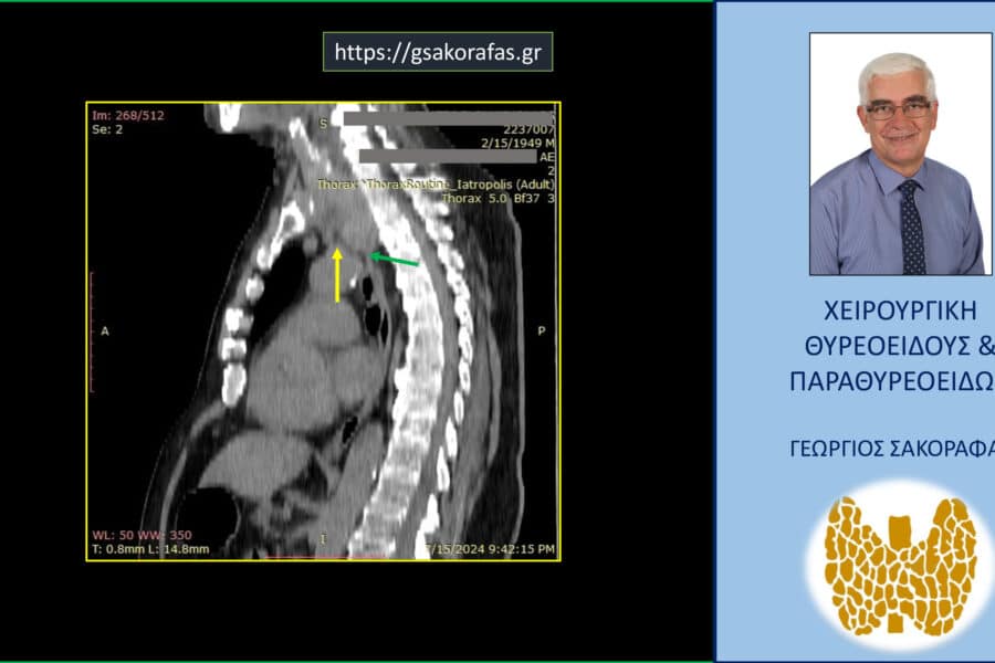 Καταδυόμενη βρογχοκήλη σε βάθος μέχρι κάτωθεν του αορτικού τόξου σε υπερήλικα ασθενή. Στην τομή αυτή της αξονικής τομογραφίας φαίνεται από τα πλάγια η επέκταση του κάτω πόλου του αριστερού λοβού του θυρεοειδούς (πράσινο βέλος) κάτωθεν του άνω ορίου του αορτικού τόξου (κίτρινο βέλος).