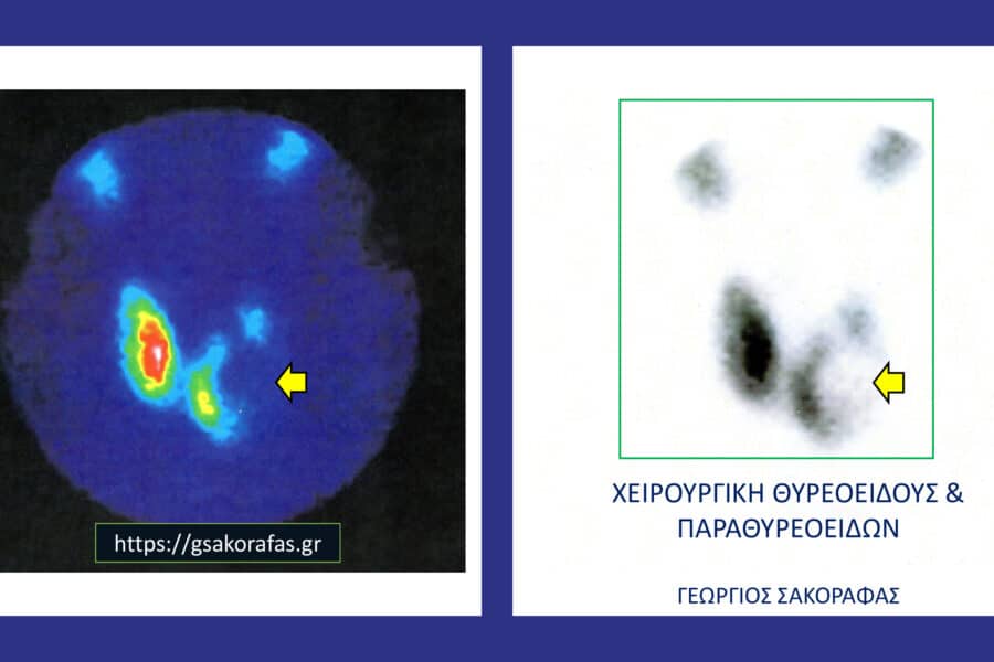 Ψυχρός όζος θυρεοειδούς