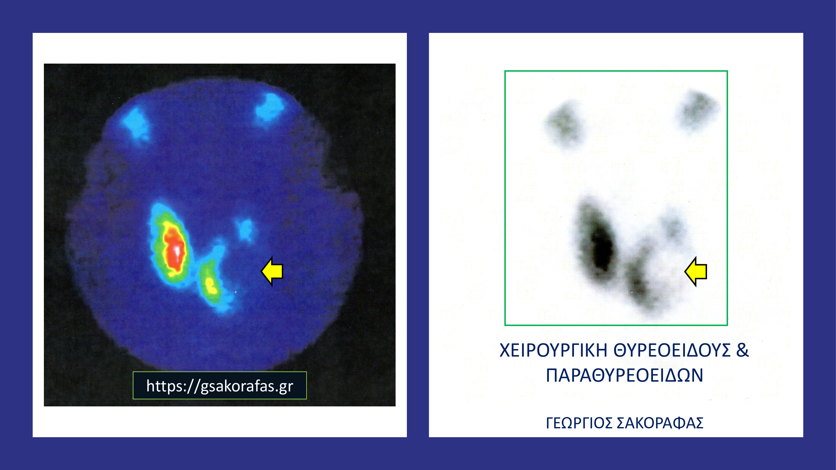 Ψυχρός όζος θυρεοειδούς – εικόνα (σε ασθενή μας)